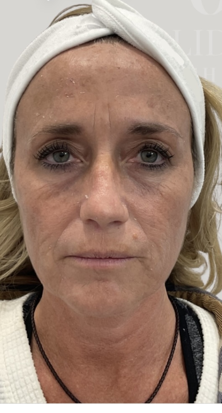 Before Refine and Renew skin rejuvenation treatment
